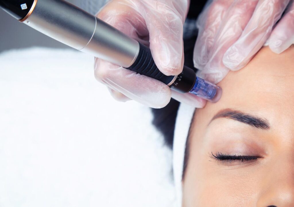 microneedling treatment in geneva - beauty art pro