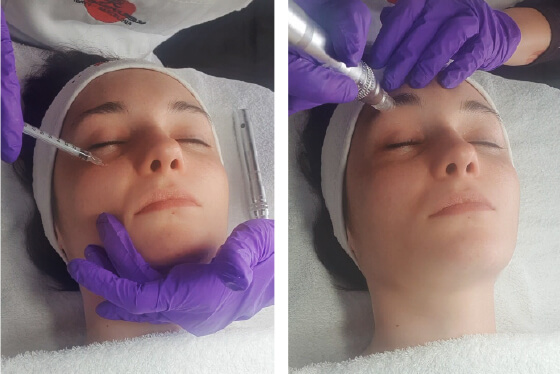 microneedling eye lift process 6