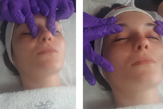 microneedling eye lift process 9