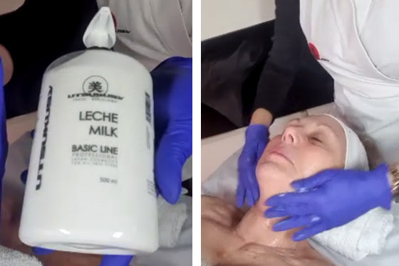 microneedling neck lift process 1