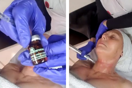microneedling neck lift process 7