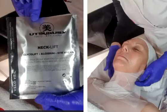 microneedling neck lift process 8