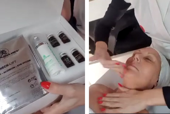 microneedling neck lift process 9